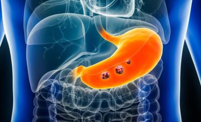 66bb5f30fa7afbc3ac09c763_Gastric-cancer