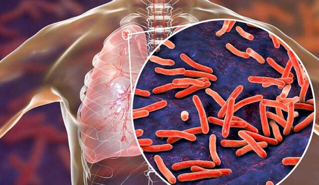 67fe3d4f036b5127e3771ad9_How-PoCT-AI-guided-lung-ultrasound-boosts-TB-diagnosis
