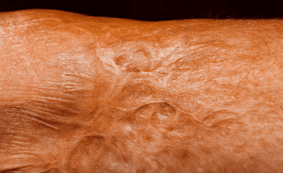 68ccfde60476ea03f59588dd_cream-scars-disappear-1