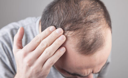 69008a925dc97ca523bd02e0_Balding-Hair-Loss-Man